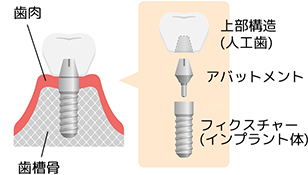 インプラント体とアバットメントをネジ式で固定