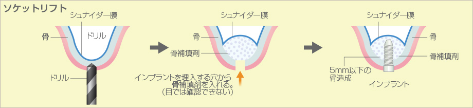 ソケットリフト