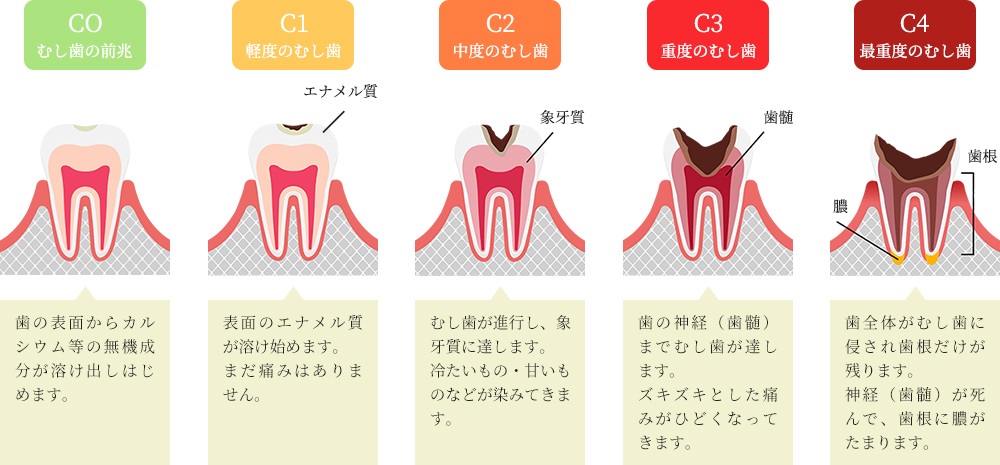 むし歯はこのように進行します