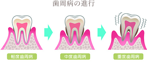 歯周病の進行の図