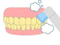 歯面のクリーニング